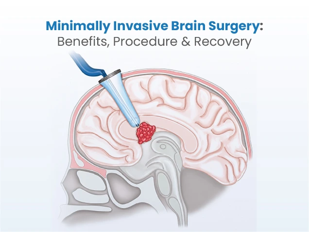 Minimally Invasive Brain Surgery: Benefits, Procedure & Recovery